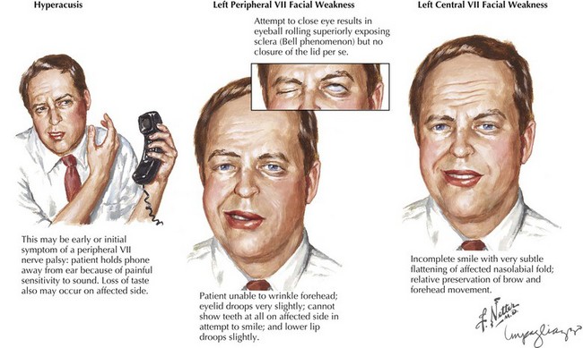 Facial paralysis diagnosis