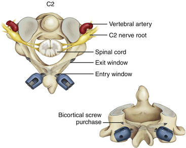 Instrumentation and Stabilization of the Pediatric Spine: Technical