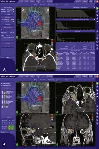 Image Guided Robotic Radiosurgery Neupsy Key