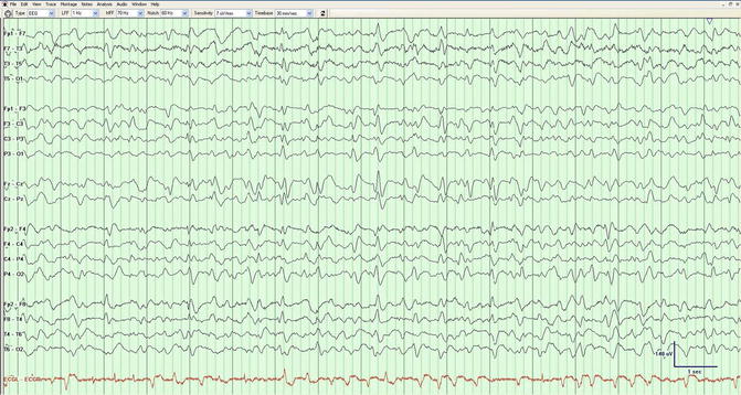 Which EEG Patterns Deserve Treatment in the ICU? | Neupsy Key
