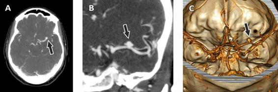 Non Traumatic Subarachnoid Hemorrhage Neupsy Key