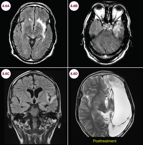 Epilepsy | Neupsy Key