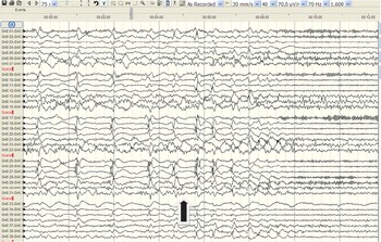 Chapter 17 – MRI-negative refractory focal epilepsy in childhood ...