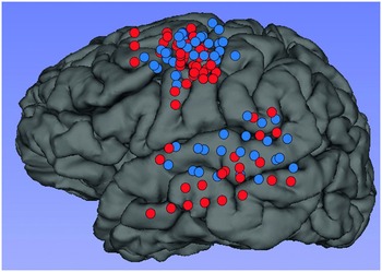 Chapter 13 – Cortical mapping in MRI-negative epilepsy surgery | Neupsy Key