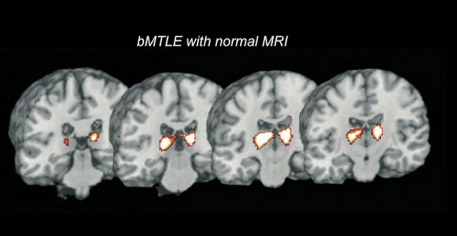 Chapter 5 Imaging Genetics For Benign Mesial Temporal Lobe Epilepsy Neupsy Key