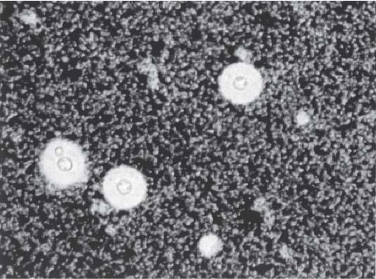 disseminated cryptococcus india ink stain