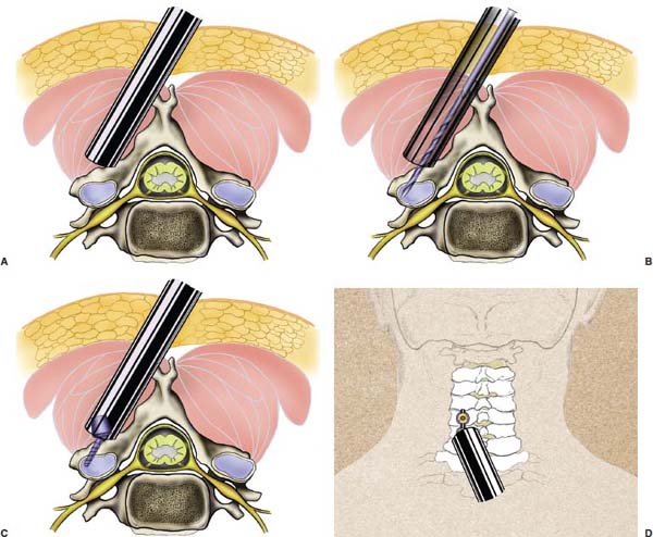 Using Dermabond for Wound Closure in Lumbar and Cervical Neurosurgical  Procedures