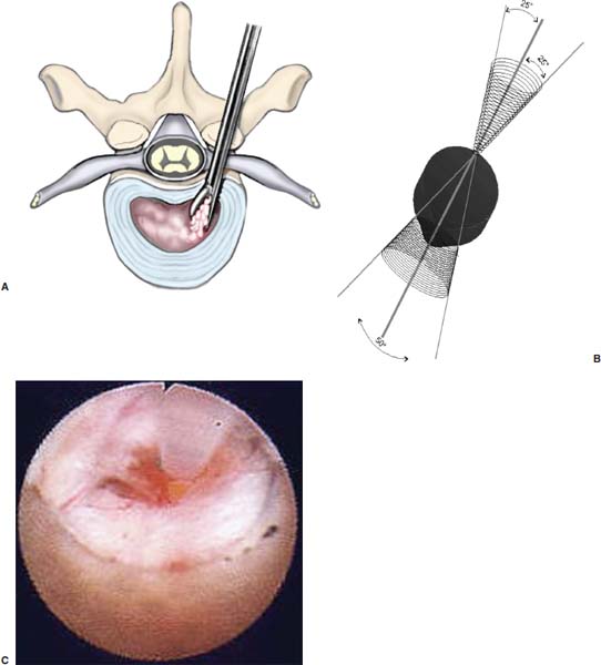 Posterolateral Endoscopic Thoracic Diskectomy | Neupsy Key