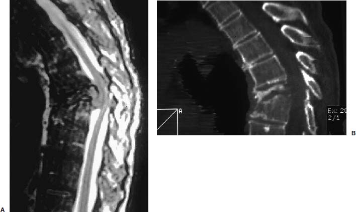 Thoracoscopic Management of Spinal Tumors | Neupsy Key