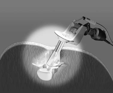 Endoscopic Pedicle Screw Instrumentation And Decompression Neupsy Key