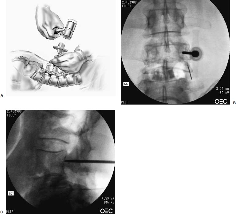 Endoscopic Percutaneous Lumbar Pedicle Screw Fixation Neupsy Key