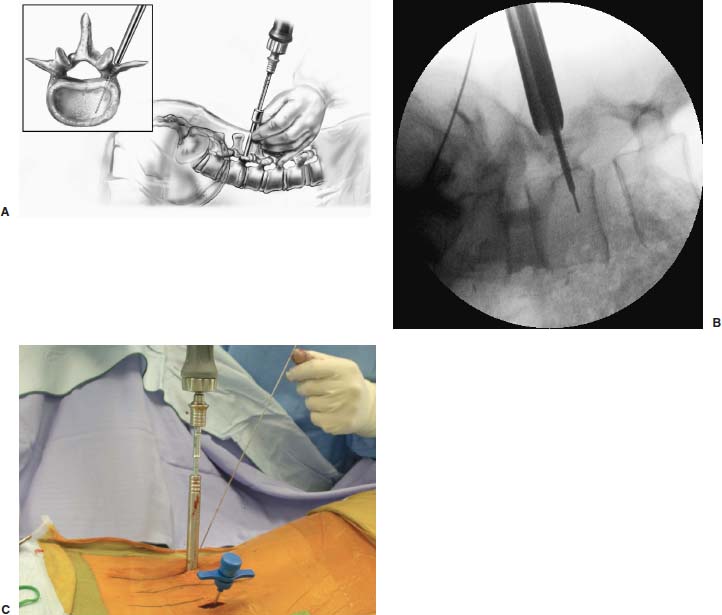 Endoscopic Percutaneous Lumbar Pedicle Screw Fixation Neupsy Key