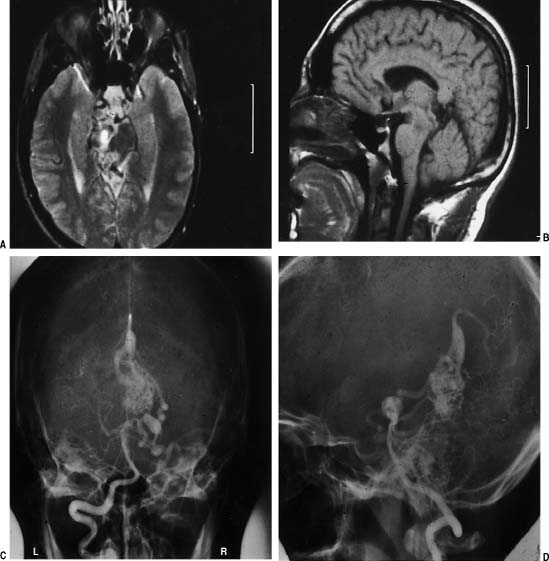 Surgical Treatment Of Cerebral Arteriovenous Malformations Neupsy Key 7913