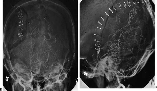 Surgical Treatment Of Cerebral Arteriovenous Malformations Neupsy Key 9840