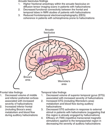 treatment for auditory hallucinations