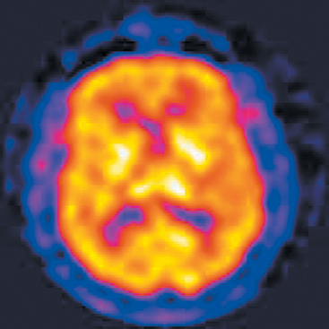 74: Neuroimaging In Psychiatry | Neupsy Key