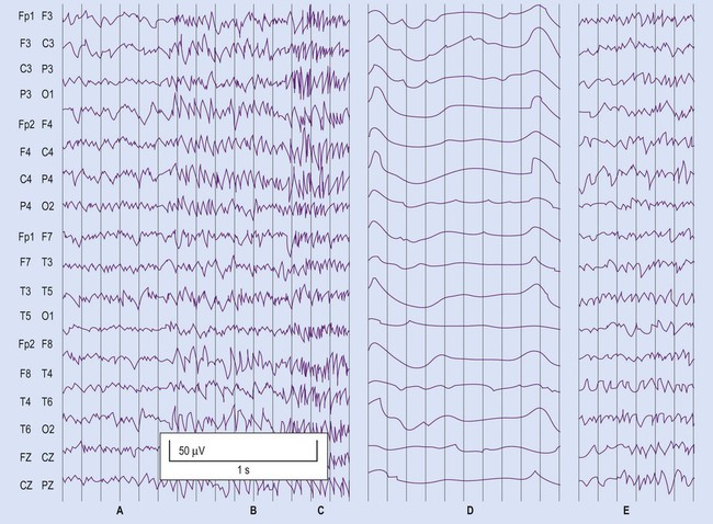 normal eeg monitor vs epilepsy
