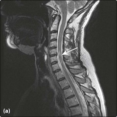 sclerosis multiple mri spine ms cervical cord spinal ii signal scan t2 changes showing myelitis transverse