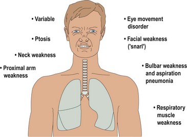 Disorders of the neuromuscular junction | Neupsy Key