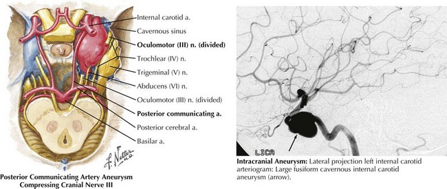 Cranial Nerves Iii Iv And Vi Neupsy Key 3860