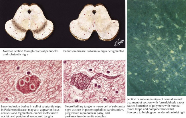 Pathology Of Parkinsons Disease