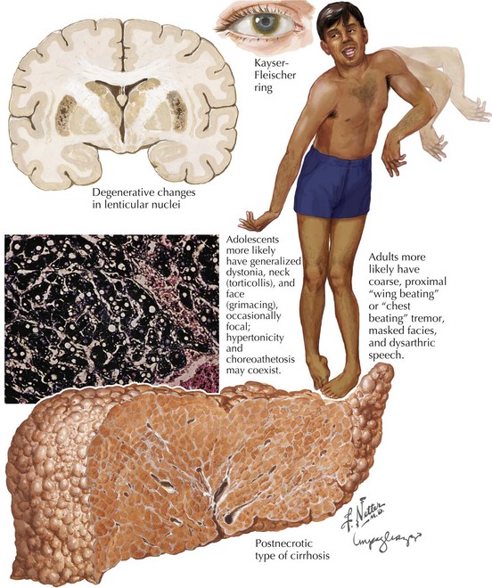 Wilson Disease | Neupsy Key