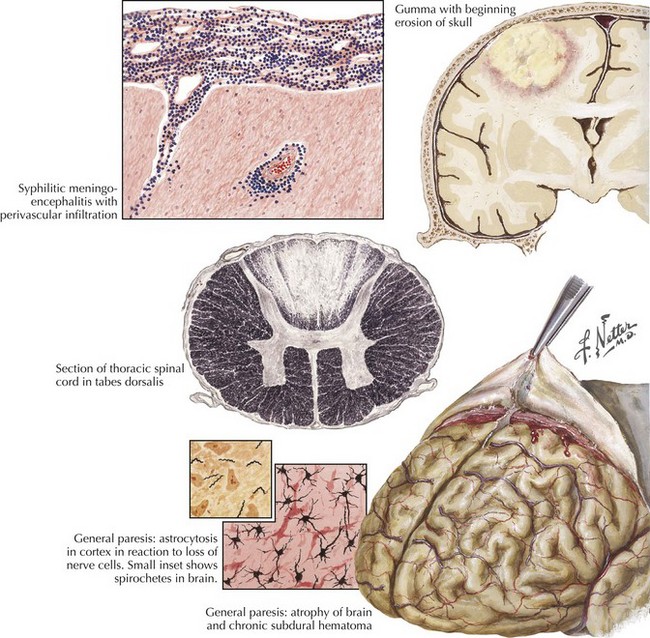 Bacterial Diseases | Neupsy Key