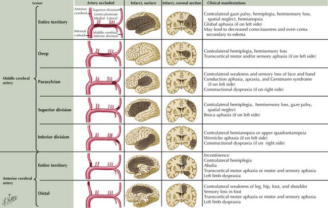 presentation of aca stroke