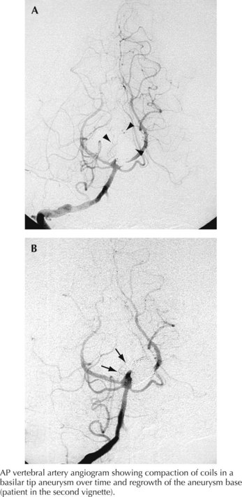 Intracerebral Hemorrhage | Neupsy Key