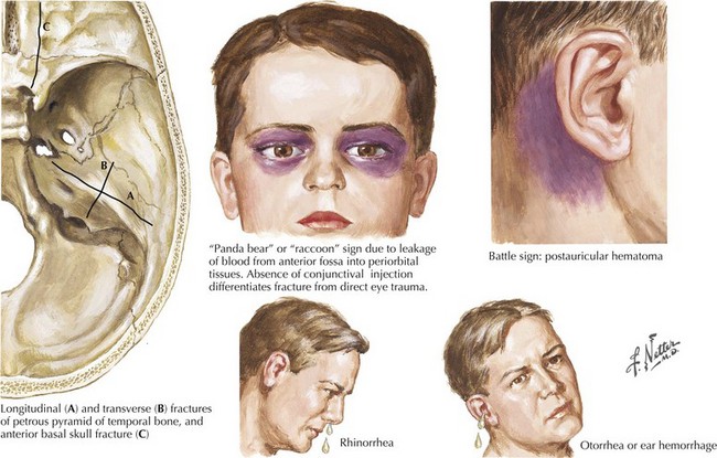 Base Of Skull Fracture Signs