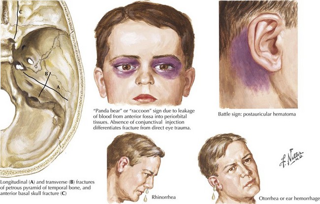 skull fracture signs