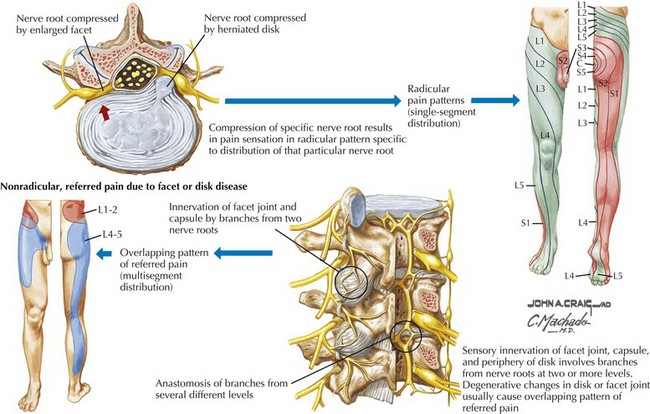 Lumbar Nerve Root Disorder Treatment