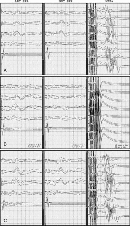 Clinical Neurophysiology: Electroencephalography And Evoked Potentials ...