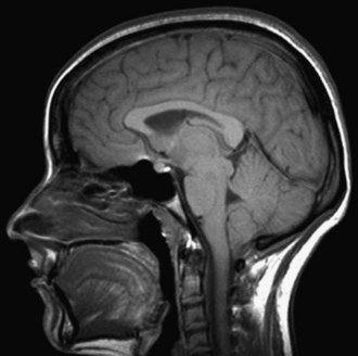 Headache and Other Craniofacial Pain | Neupsy Key