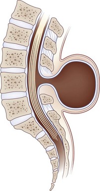 Disorders of Bones, Joints, Ligaments, and Meninges | Neupsy Key