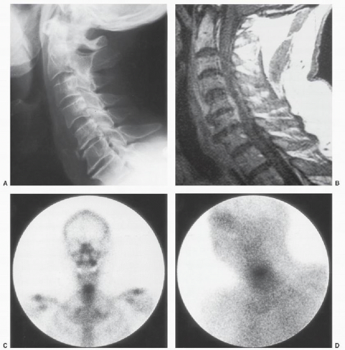 Cervical Spinal Infections | Neupsy Key