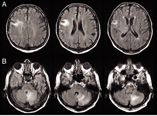 Hematological Tumors 