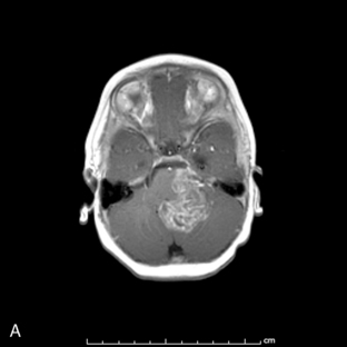 Pediatric Neuro-Oncology | Neupsy Key