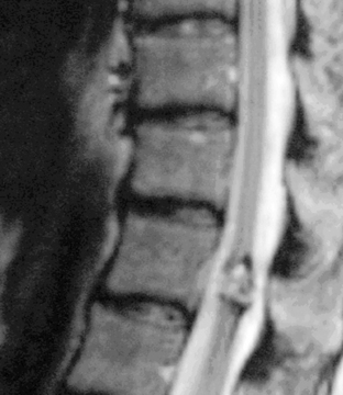 Management of Intramedullary Spinal Cord Tumors | Neupsy Key