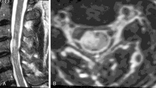 Intramedullary Lesions Multiple Neupsy Key