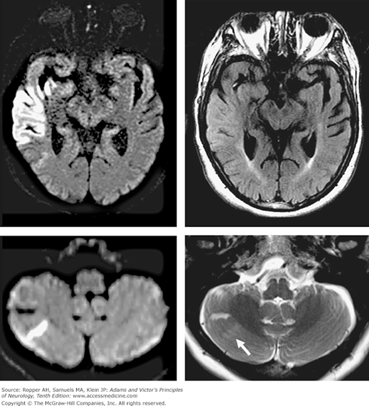 Chapter 34. Cerebrovascular Diseases | Neupsy Key