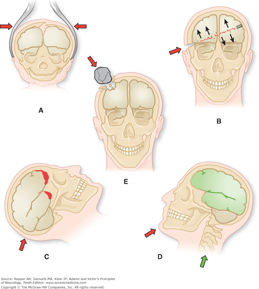 Chapter 35. Craniocerebral Trauma | Neupsy Key