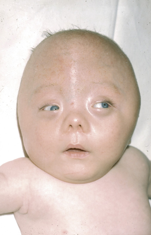 Craniofacial Syndromes Neupsy Key 