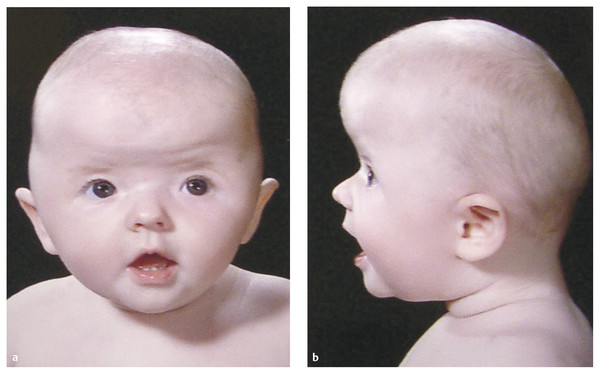 Craniofacial Syndromes | Neupsy Key