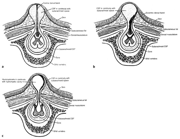 Spinal Meningoceles | Neupsy Key