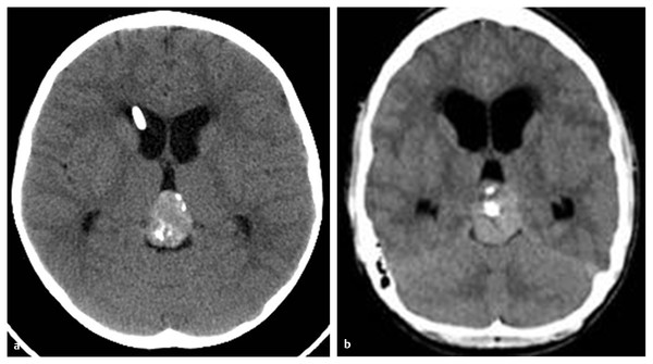 Pineal Region Tumors Neupsy Key