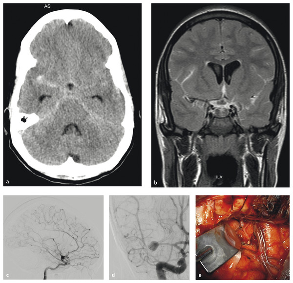 intracerebral aneurysm