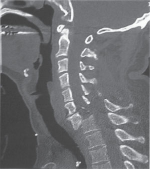 Traumatic Spondyloptosis of the Cervical Spine | Neupsy Key