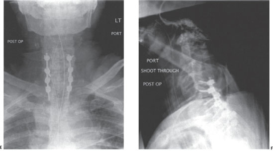 Cervical Fractures in Diffuse Idiopathic Skeletal Hyperostosis | Neupsy Key