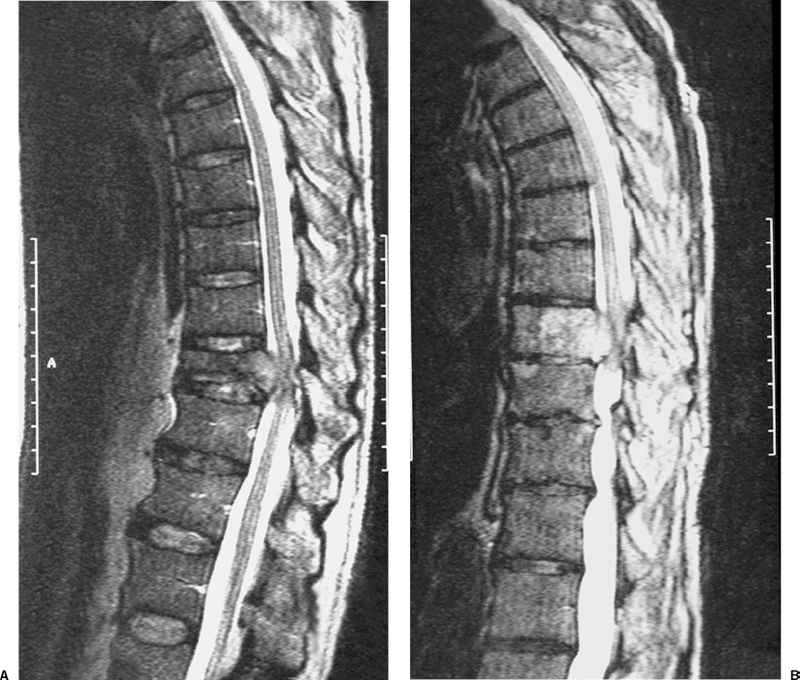 pathological fracture cancer